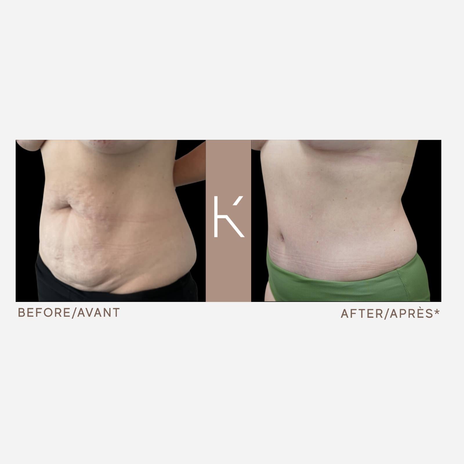 Tummy Tuck and Bilateral Liposuction to Hips - Case #44473 - The Plastic  Surgery Group