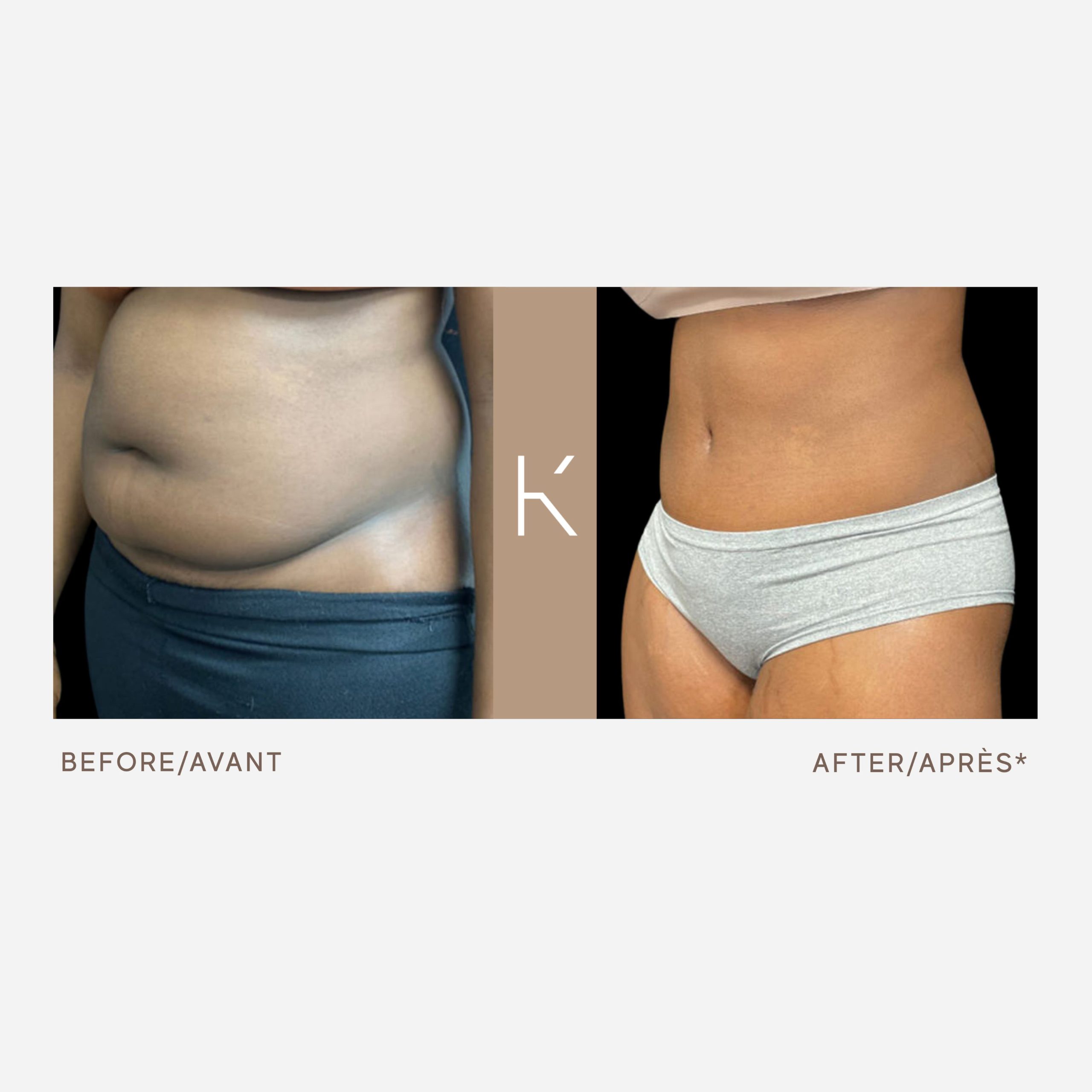 Patient K - 4 weeks Post-Operative Tummy Tuck and Sub-muscular