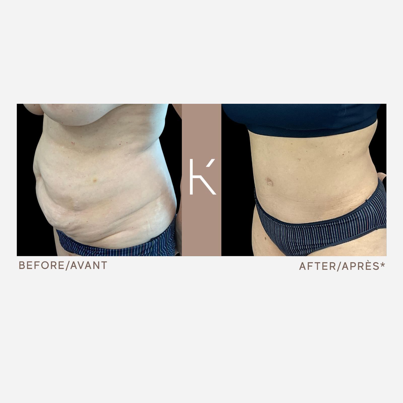 DKS Before and After - Schwarz Plastic Surgery Clinic in Montreal